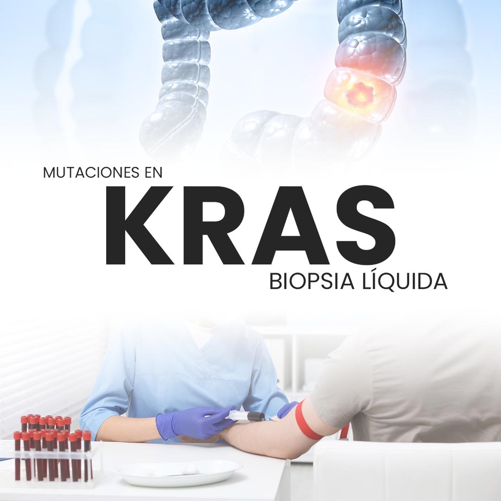 Mutaciones en KRAS (Biopsia Líquida)