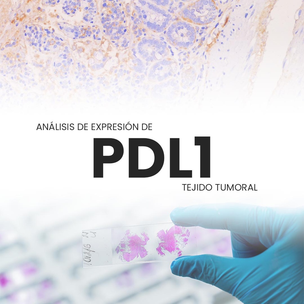 Análisis de expresión de PD-L1(Tejido tumoral)