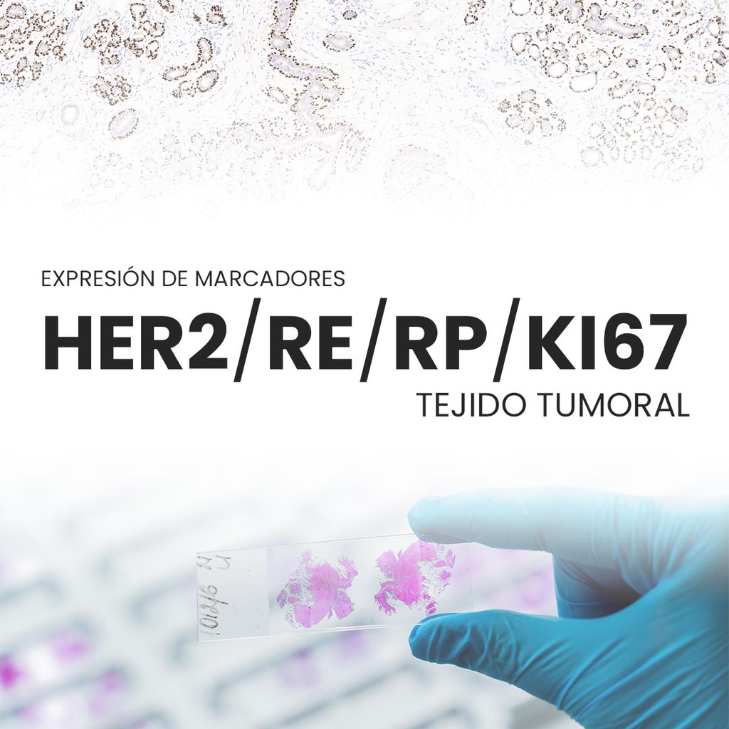 Expresión de marcadores HER2/RE/RP/Ki67 (Tejido tumoral ...